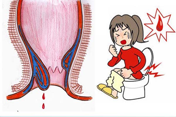 Đi đại tiện ra máu khám ở đâu