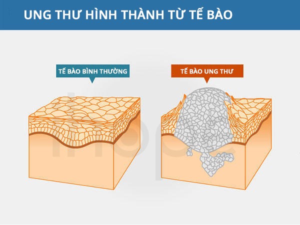 Chữa ung thư bằng liệu pháp nhiệt trị (hyperthermia therapy) Chữa ung thư bằng liệu pháp nhiệt trị (hyperthermia therapy)