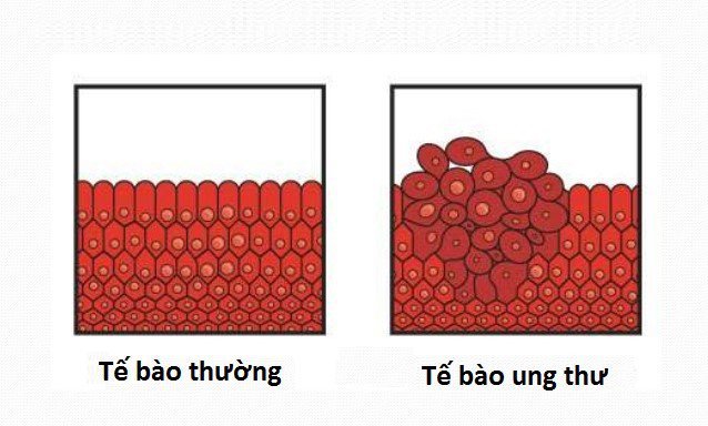 Chữa ung thư bằng liệu pháp nhiệt trị (hyperthermia therapy) Chữa ung thư bằng liệu pháp nhiệt trị (hyperthermia therapy)