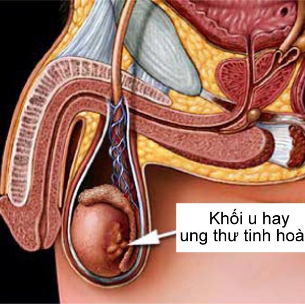 Tìm hiểu quá trình phẫu thuật cắt bỏ tinh hoàn
