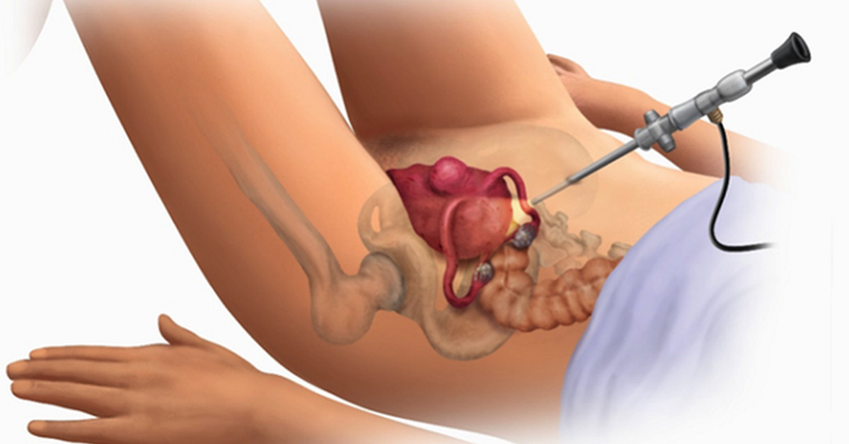 Điều trị sa sinh dục tái phát