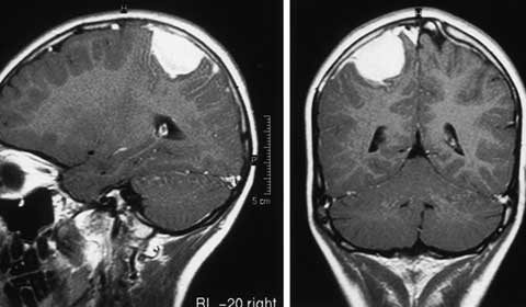Triệu chứng và cách chữa trị u màng não Triệu chứng và cách chữa trị u màng não