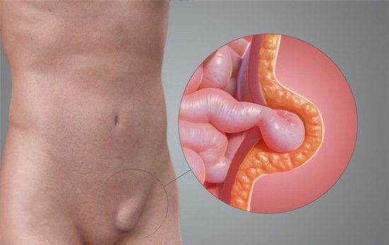 Triệu chứng ung thư tinh hoàn mà bạn cần lưu ý