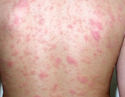 Phương pháp điều trị bệnh cho người nhiễm HIV/AIDS