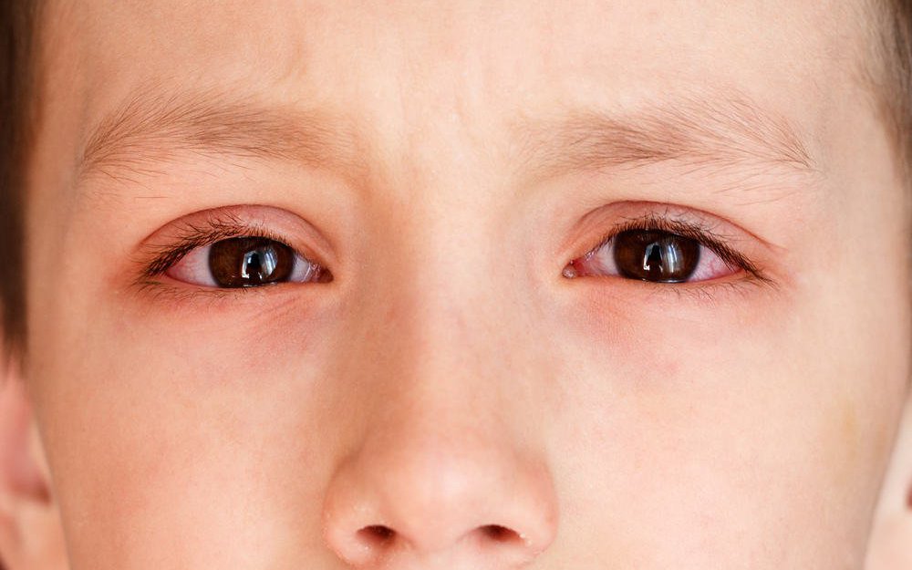 Triệu chứng và phương pháp điều trị viêm kết mạc ở trẻ sơ sinh