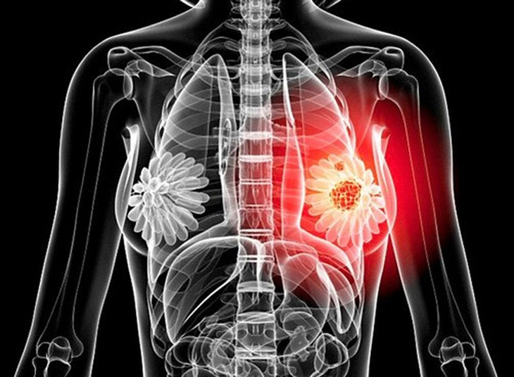 Điều trị xơ nang tuyến vú