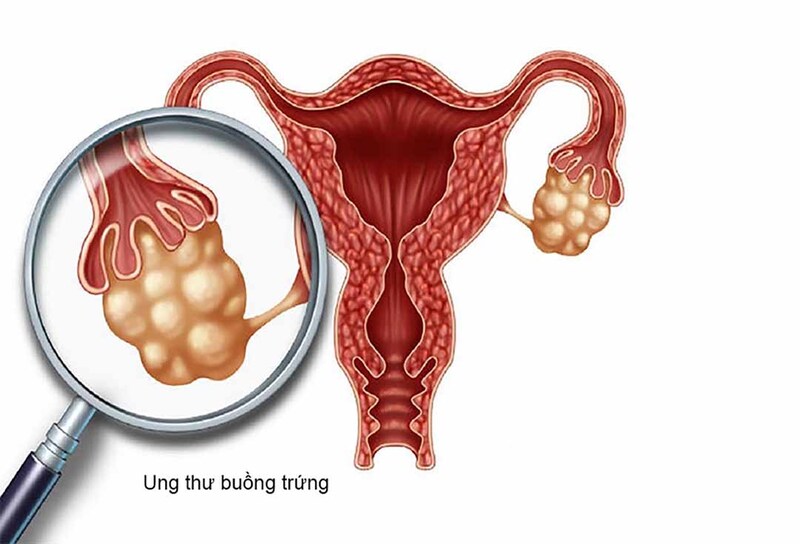 Chỉ số CA 125 có vai trò gì trong ung thư buồng trứng?