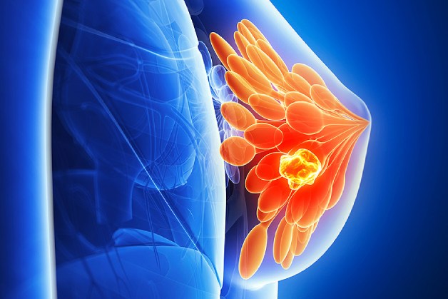 CA 15-3: Dấu ấn ung thư vú có ý nghĩa như thế nào? CA 15-3: Dấu ấn ung thư vú có ý nghĩa như thế nào?
