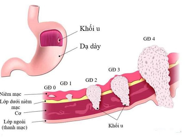 Ưu điểm của hóa trị bằng ramucirumab và paclitaxel cho ung thư dạ dày thực quản Ưu điểm của hóa trị bằng ramucirumab và paclitaxel cho ung thư dạ dày thực quản