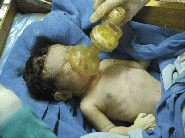 Hội chứng hít phân su nguy hiểm như thế nào? Hội chứng hít phân su nguy hiểm như thế nào?