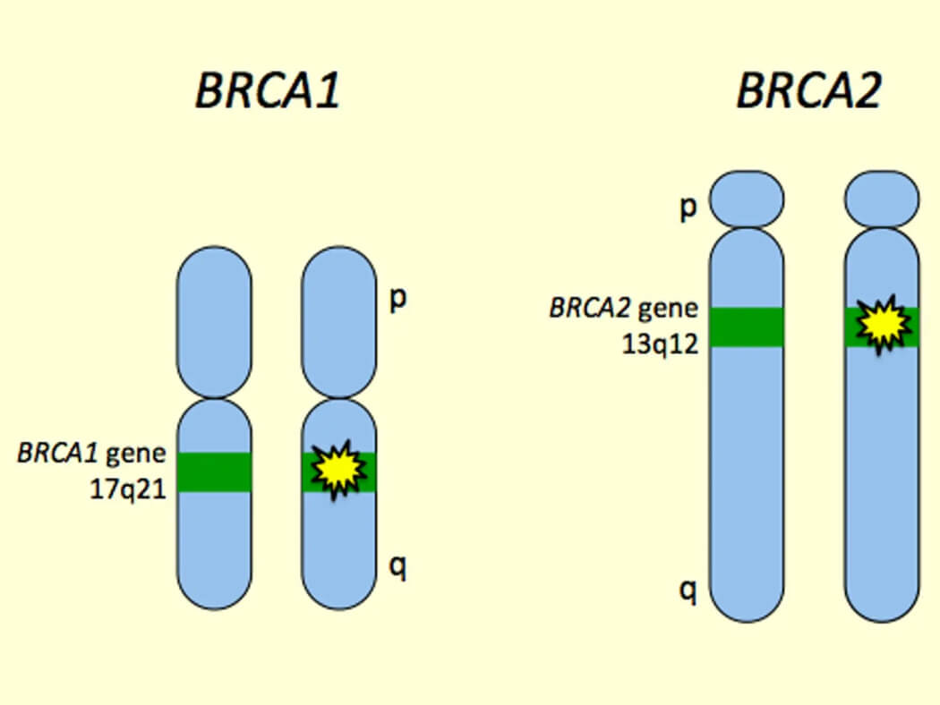 Xét nghiệm gen BRCA cho bệnh ung thư vú: Nguy cơ mắc gen đột biến, phương pháp thực hiện, những lưu ý, ý nghĩa của việc xét nghiệm, nhận biết khi nào cần xét nghiệm Xét nghiệm gen BRCA cho bệnh ung thư vú: Nguy cơ mắc gen đột biến, phương pháp thực hiện, những lưu ý, ý nghĩa của việc xét nghiệm, nhận biết khi nào cần xét nghiệm