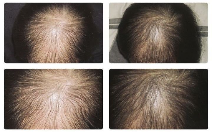 Phương pháp mọc tóc sau hoá trị ung thư Phương pháp mọc tóc sau hoá trị ung thư
