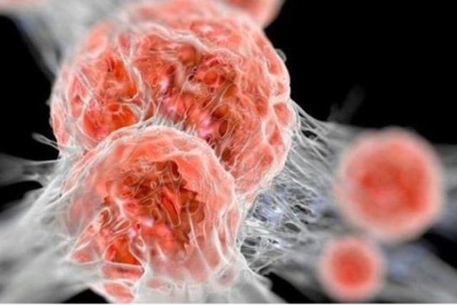 Sự khác biệt giữa khối u lành tính và khối u ác tính phổ biến nhất hiện nay Sự khác biệt giữa khối u lành tính và khối u ác tính phổ biến nhất hiện nay