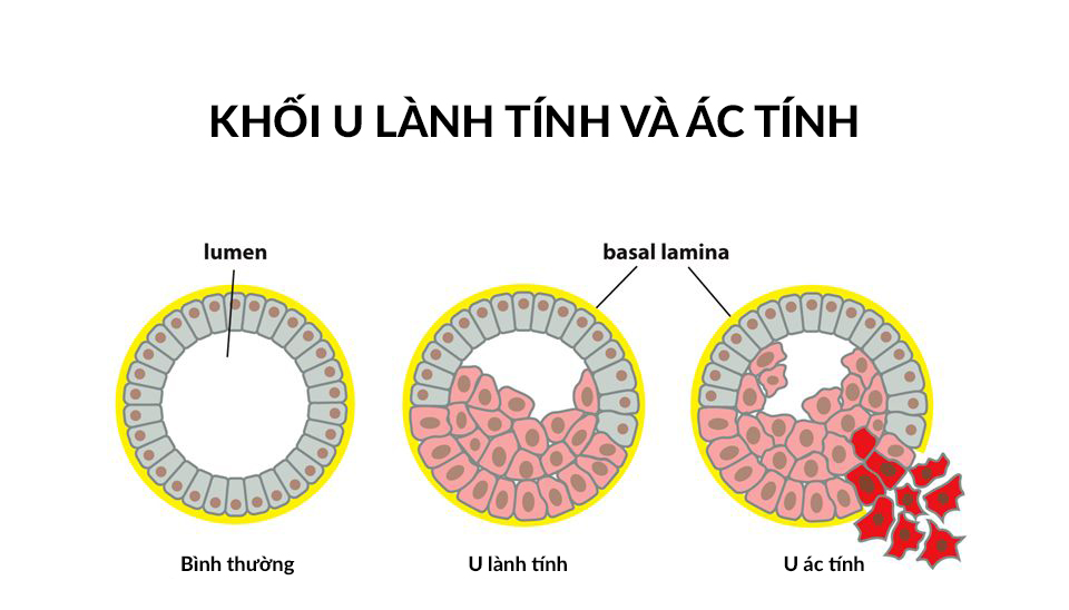 Sự khác biệt giữa khối u lành tính và khối u ác tính phổ biến nhất hiện nay Sự khác biệt giữa khối u lành tính và khối u ác tính phổ biến nhất hiện nay