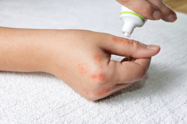 Đừng lo sợ khi gặp kiến ba khoang Nhận biết và xử trí khi bị kiến ba khoang đốt