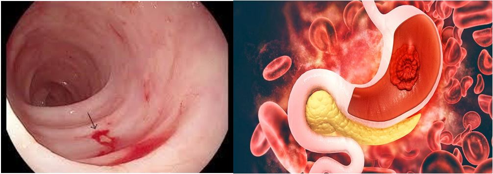 Tìm hiểu về kỹ thuật xạ hình chẩn đoán xuất huyết đường tiêu hóa ở trẻ em với SPECT/CT