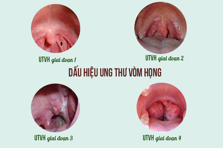 Những phương pháp phòng ngừa bệnh ung thư vòm họng giai đoạn đầu