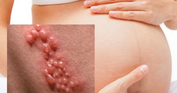 Mang thai bị nhiễm virus herpes nguy hiểm thế nào?
