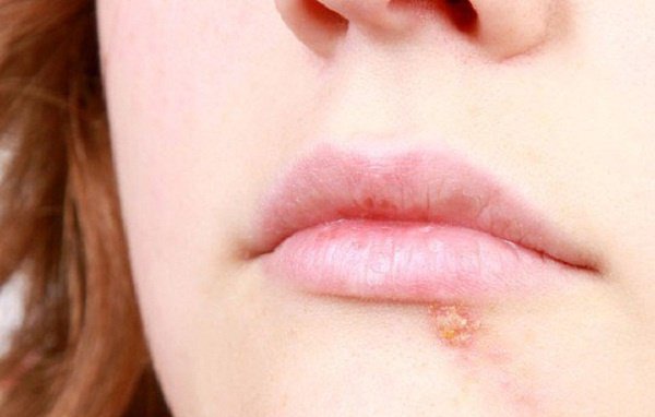 Mang thai bị nhiễm virus herpes nguy hiểm thế nào?