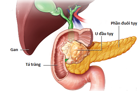 Chẩn đoán và điều trị ung thư tuyến tuỵ bạn cần biết Chẩn đoán và điều trị ung thư tuyến tuỵ bạn cần biết