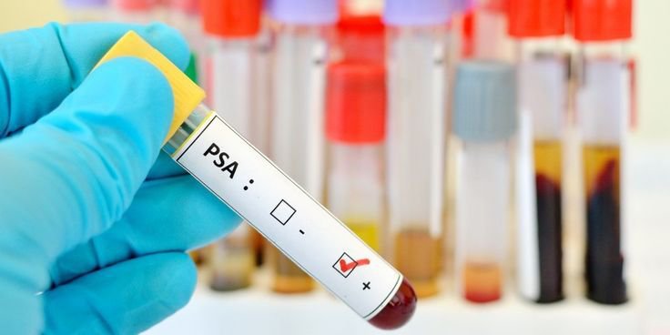 Nguyên nhân và dấu hiệu nhận biết chỉ số PSA tăng Nguyên nhân và dấu hiệu nhận biết chỉ số PSA tăng