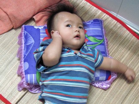 Dấu hiệu nhận biết và cách chăm sóc trẻ mắc bệnh bại não