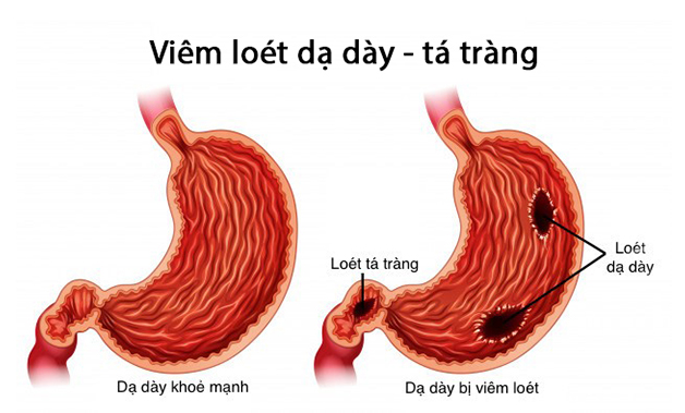 Phương pháp điều trị viêm loét dạ dày tá tràng