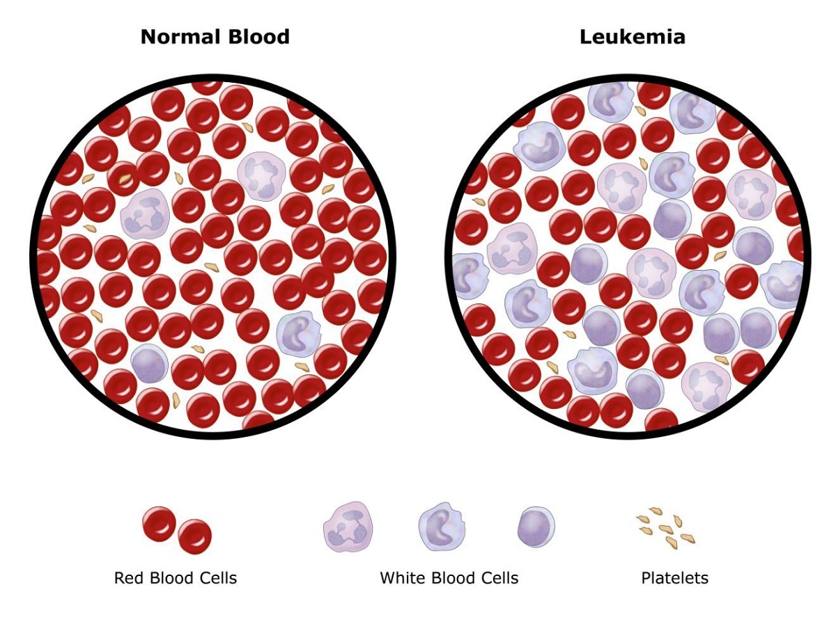 Triệu chứng và cách chữa trị cho bệnh Leukemia cấp