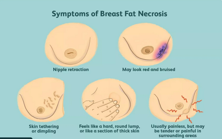 Triệu chứng và cách nhận biết sớm mô vú đặc