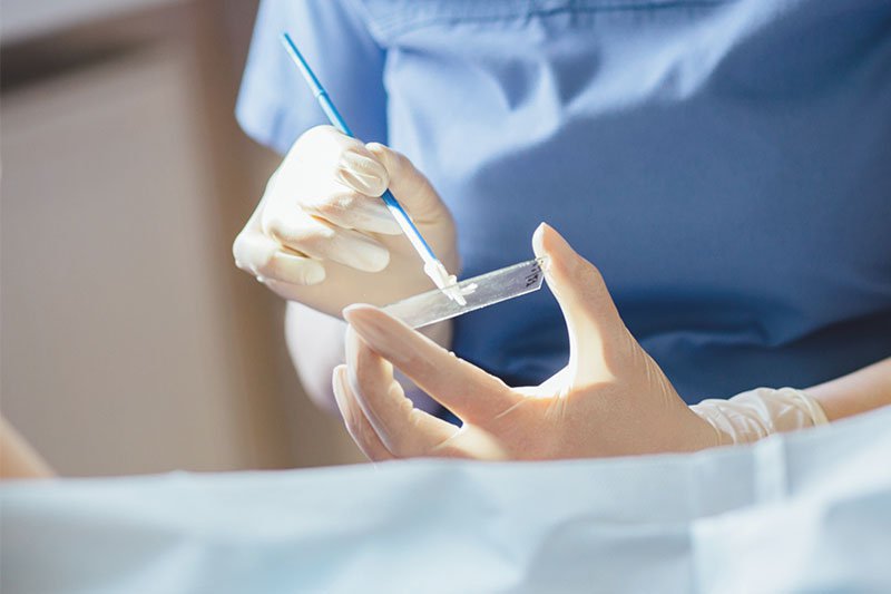 Phương pháp xét nghiệm PAP sàng lọc ung thư cổ tử cung