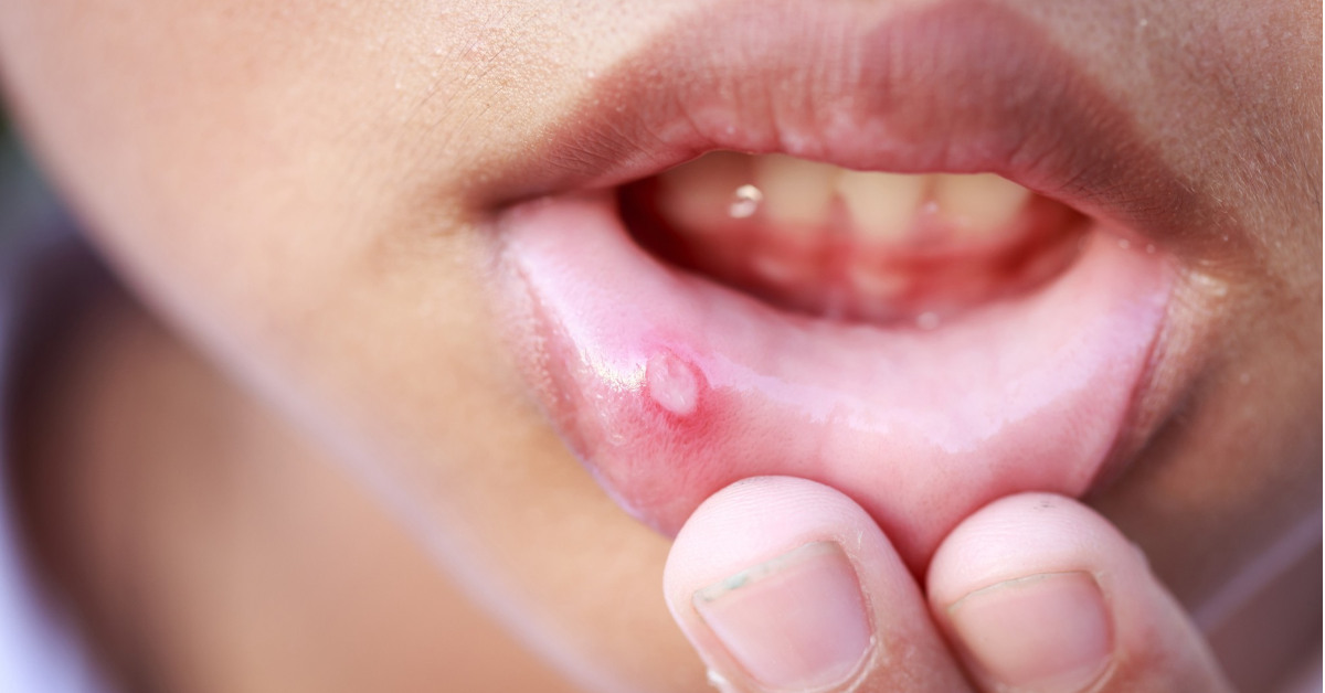 Giai đoạn phát triển của ung thư vòm họng