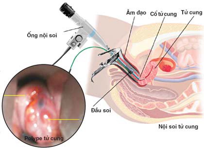 Nội soi buồng tử cung: Những điều cần biết Nội soi buồng tử cung: Những điều cần biết
