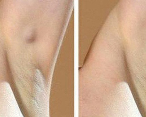 Cảnh giác việc nổi hạch ở nách có thể là ung thư vú