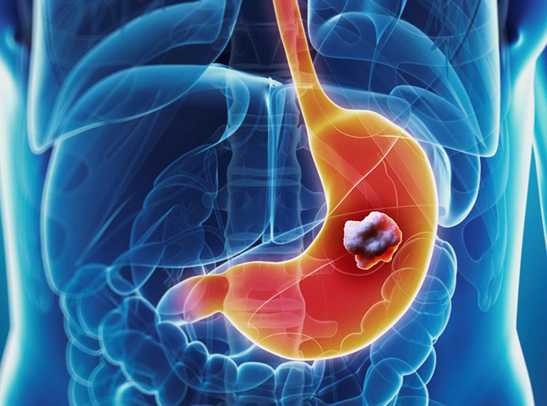 Tìm hiểu về phác đồ điều trị viêm loét dạ dày tá tràng ở trẻ em