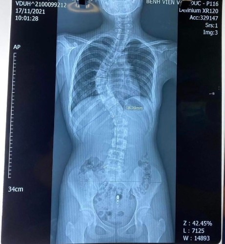 Phẫu thuật chỉnh vẹo cột sống cho trẻ và những điều cần biết Phẫu thuật chỉnh vẹo cột sống cho trẻ và những điều cần biết