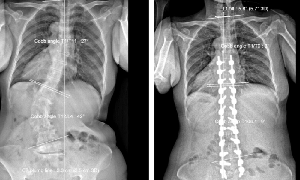 Phẫu thuật chỉnh vẹo cột sống cho trẻ và những điều cần biết Phẫu thuật chỉnh vẹo cột sống cho trẻ và những điều cần biết
