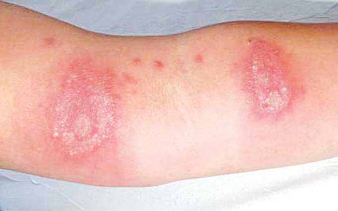 Hướng dẫn xử lý viêm da khi bị cắn bởi kiến ba khoang Cảnh giác bệnh viêm da do kiến ba khoang | Vinmec