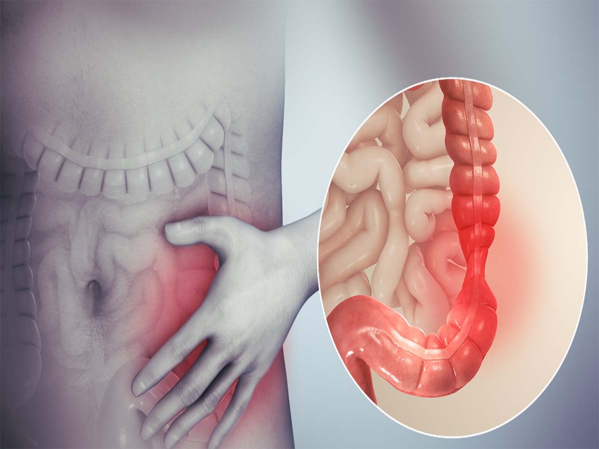 Polyp đại tràng là gì? Những ai mắc polyp đại tràng Vị trí viêm đại tràng thường đau, bạn cần nên biết