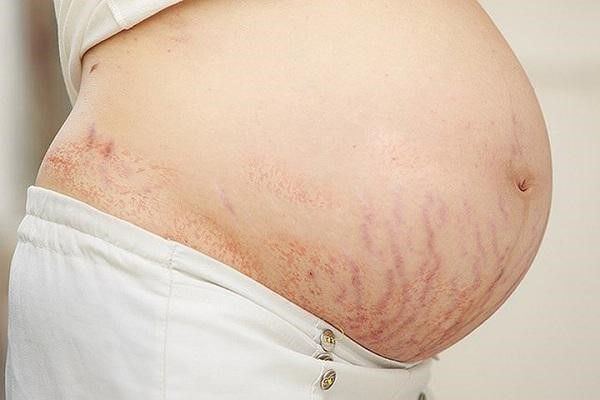Đối tượng nào dễ bị rạn da khi mang thai?