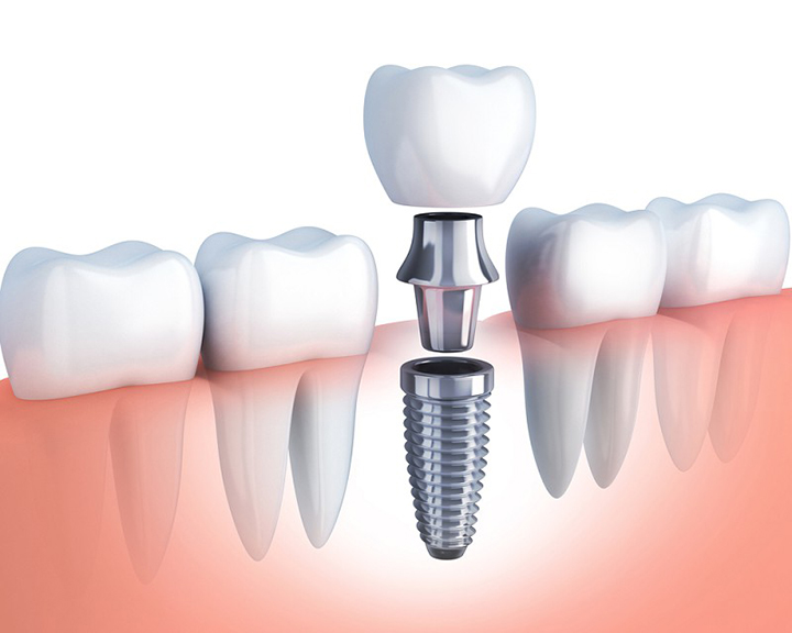 Răng gãy - Nên làm gì? Trồng răng implant có phải là trồng răng thật không? - Nha Khoa Thúy Đức