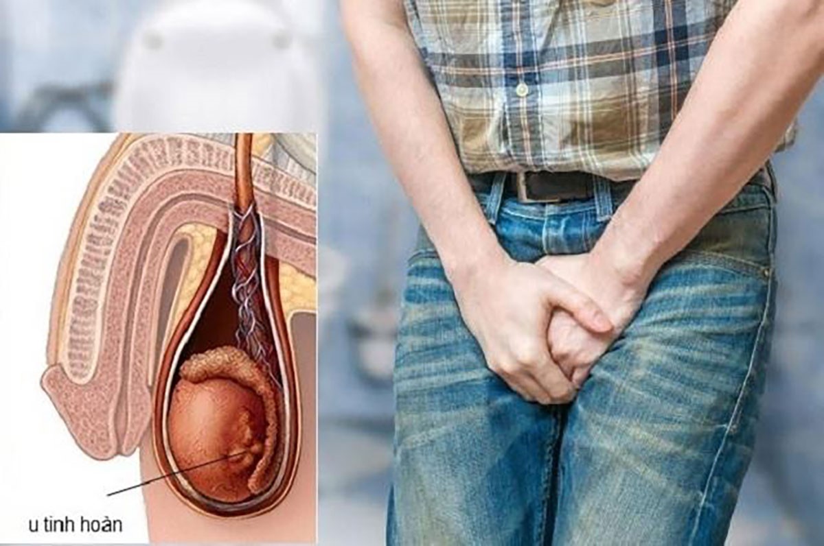 Phương pháp chẩn đoán ung thư tinh hoàn phổ biến nhất hiện nay Phương pháp chẩn đoán ung thư tinh hoàn phổ biến nhất hiện nay