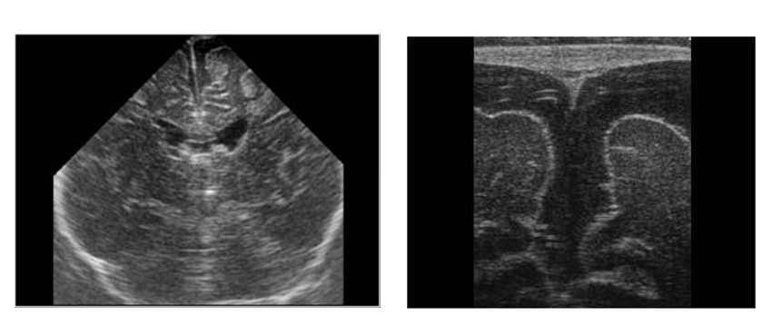 Phương pháp thực hiện chẩn đoán bằng siêu âm qua thóp