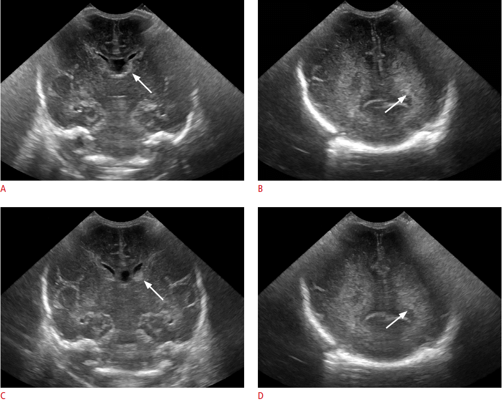 Phương pháp siêu âm qua thóp ở trẻ và những điều ba mẹ cần lưu ý