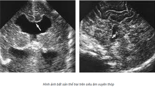 Phương pháp thực hiện chẩn đoán bằng siêu âm qua thóp