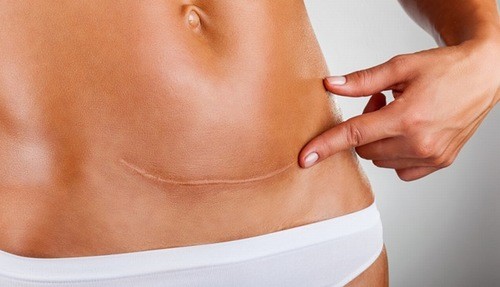 Khi nào bạn nên sinh mổ? Có cần thiết sinh mổ không? Sinh mổ lần 2 có đau hơn lần 1 không?