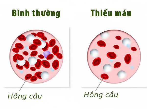 Tầm quan trọng của bổ sung sắt khi thiếu máu do chế độ dinh dưỡng