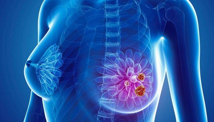 Người thiếu ngủ dễ mắc ung thư vú Ung thư vú nguy hiểm như thế nào và làm gì để phòng tránh ung thư vú?