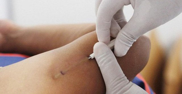 Que cấy tránh thai: Những điều cần biết