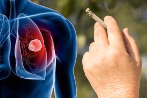 Bệnh lý đường hô hấp - Tác hại của thuốc lá Người hút thuốc lá có 7 dấu hiệu này, coi chừng ung thư phổi đã ghé thăm