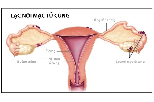 Tiến triển và biến chứng của u buồng trứng
